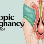 Ectopic Pregnancy